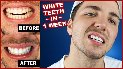 Magic wjite teeth whitening